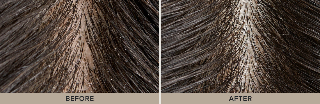 How To Do a Scalp + Hair Detox