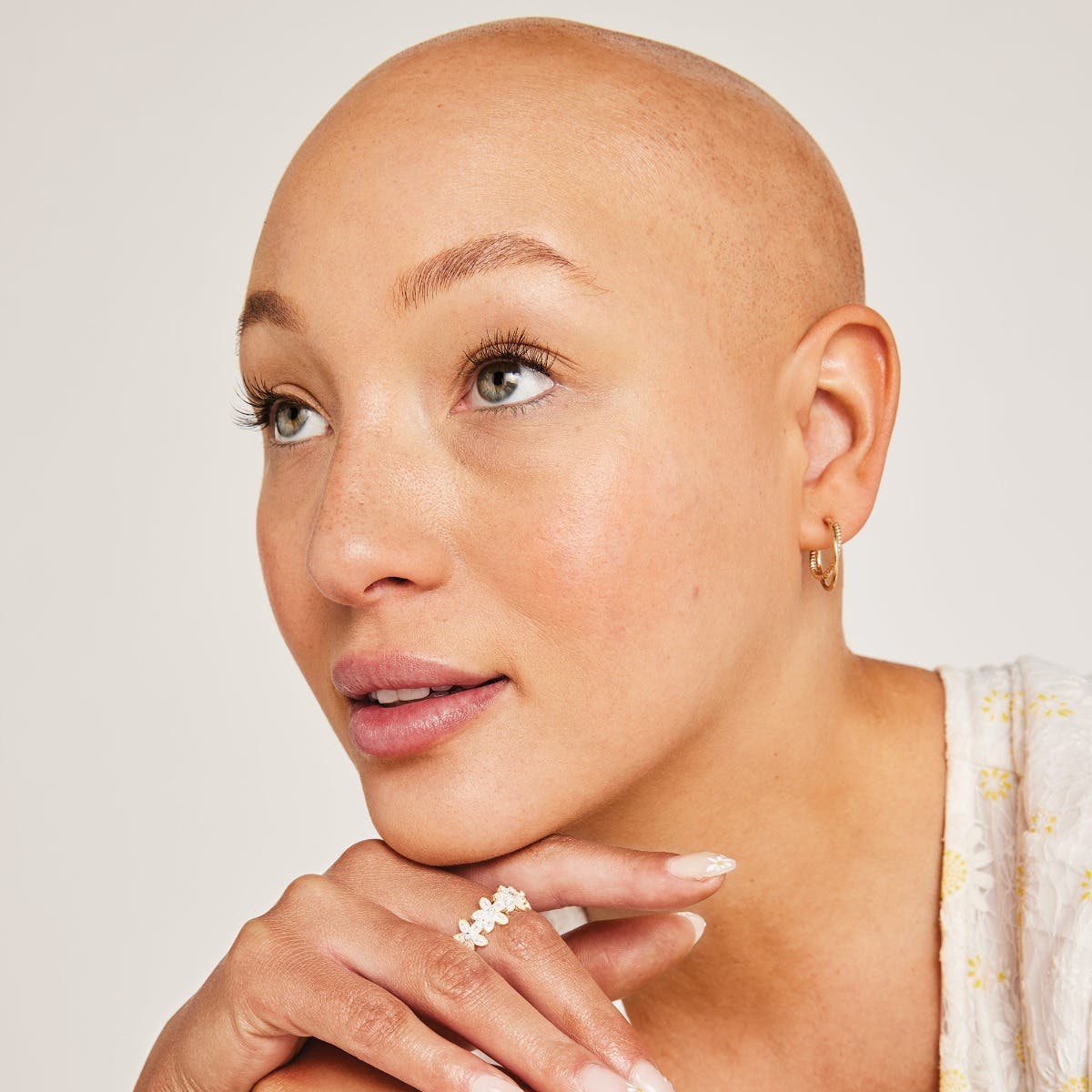 before/after image of model hairline